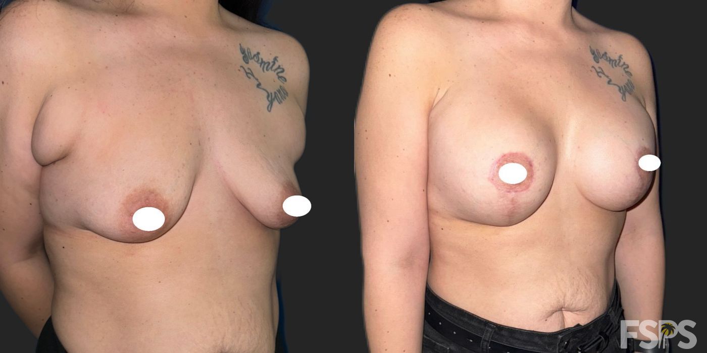 Breast Augmentation - Thumbnail 2