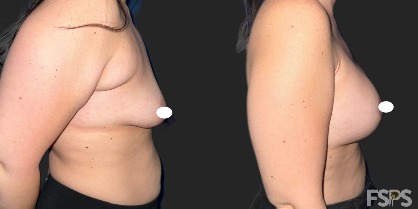 Breast Augmentation - Thumbnail 5