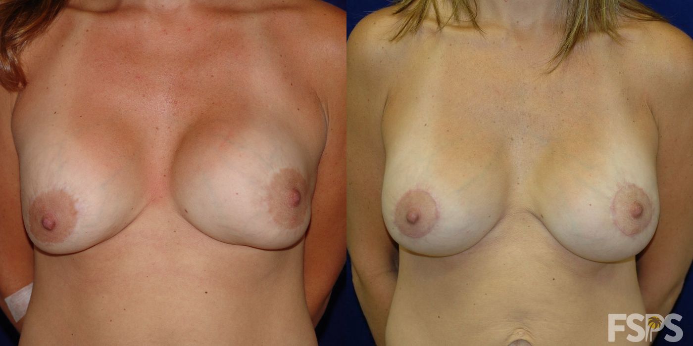 Breast Augmentation with Lift - Thumbnail 3