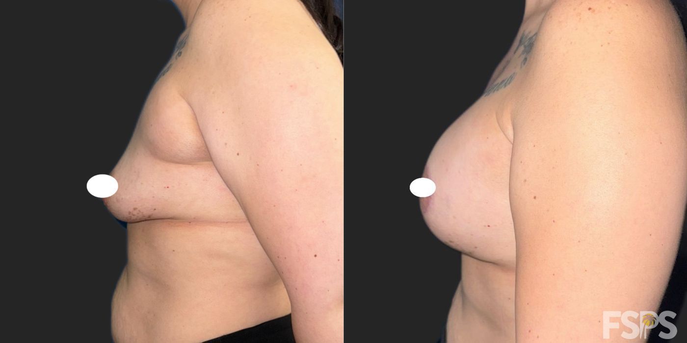 Breast Augmentation - Thumbnail 4