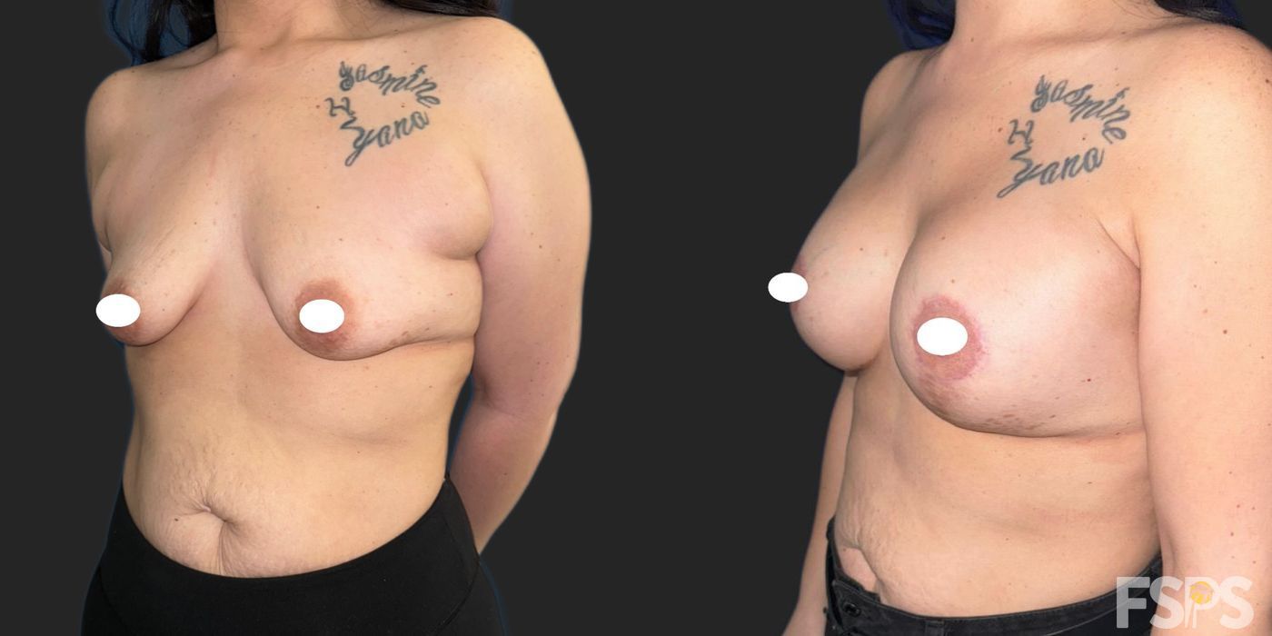 Breast Augmentation - Thumbnail 3