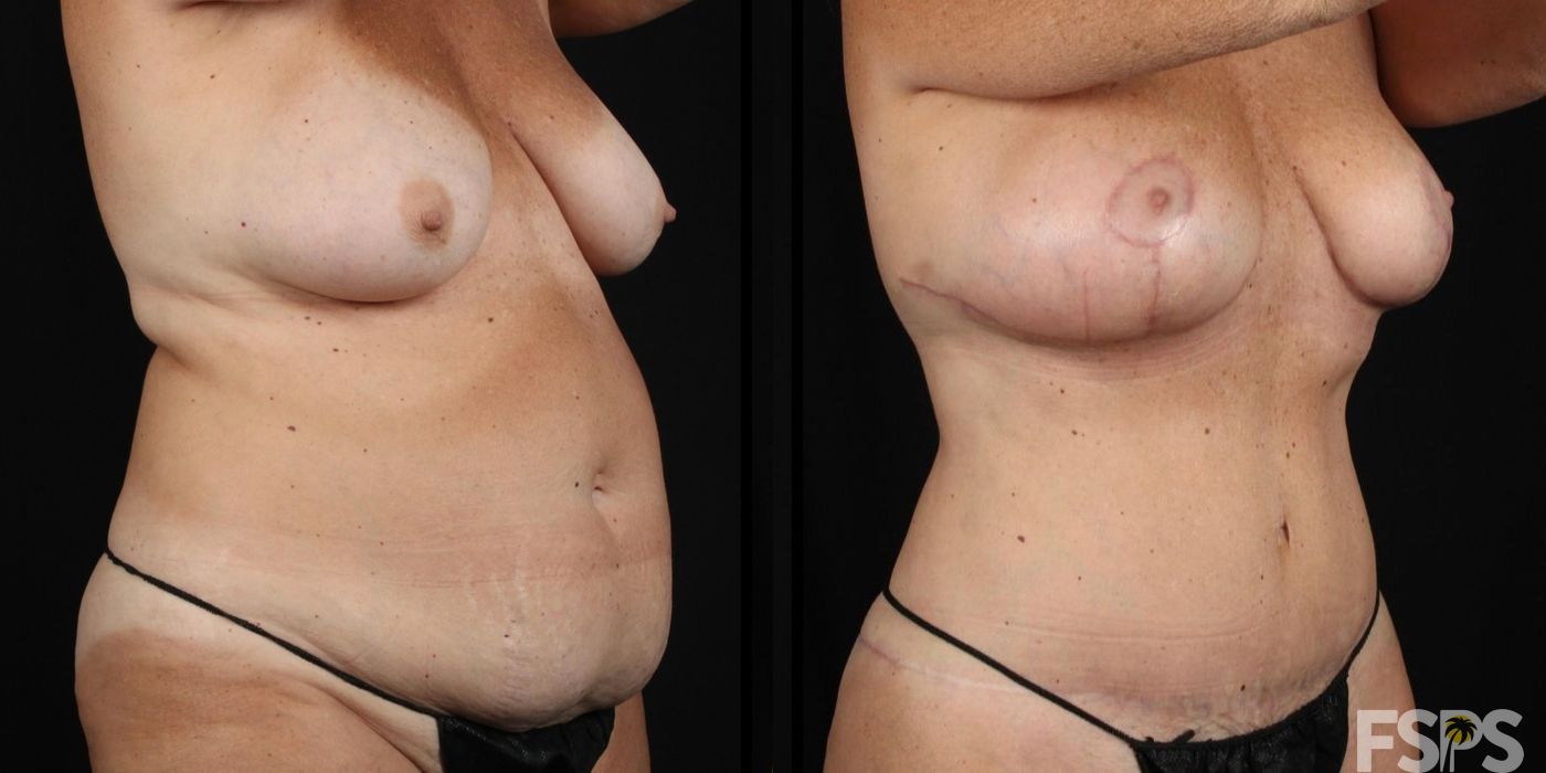 Mommy Makeover - Case 22745