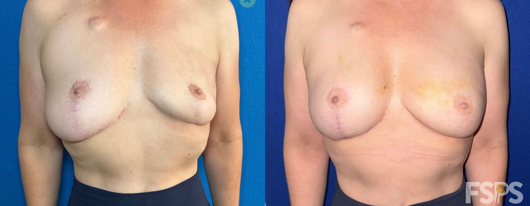 Breast Lift - Case 22954