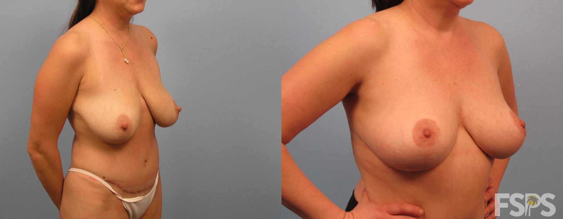Breast Lift - Thumbnail 2