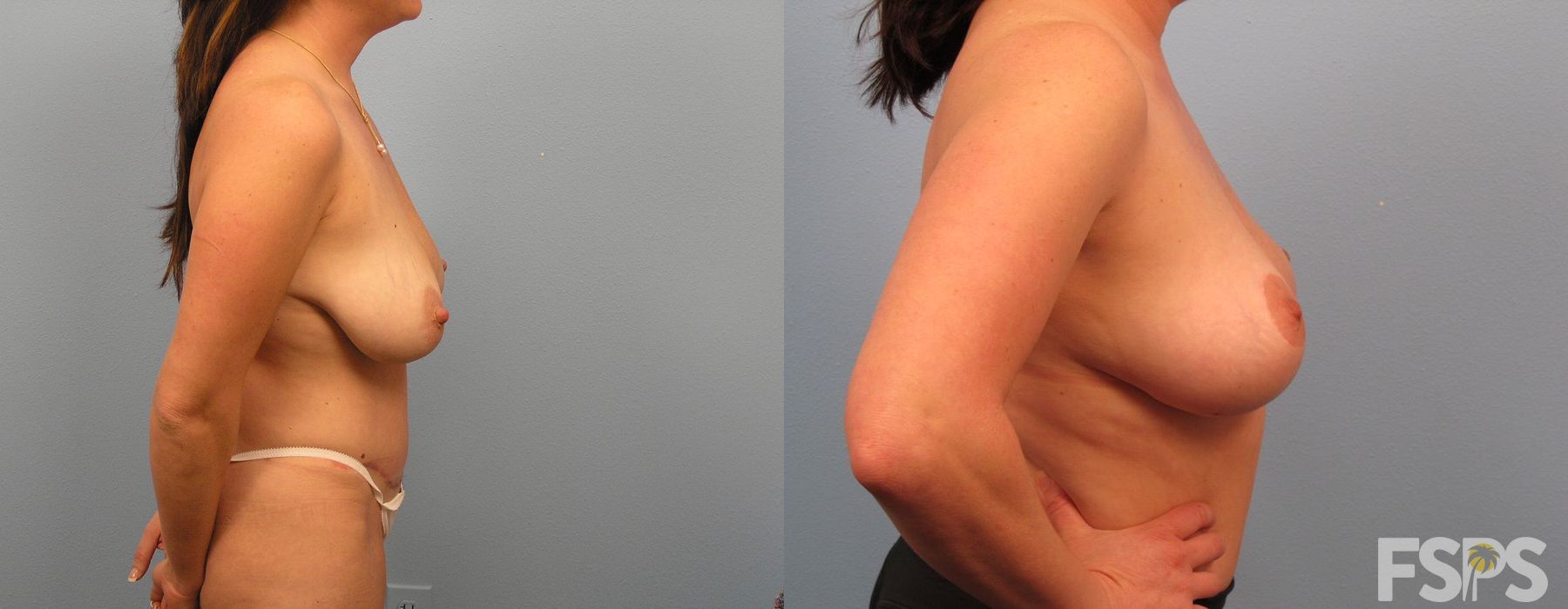 Breast Lift - Thumbnail 3