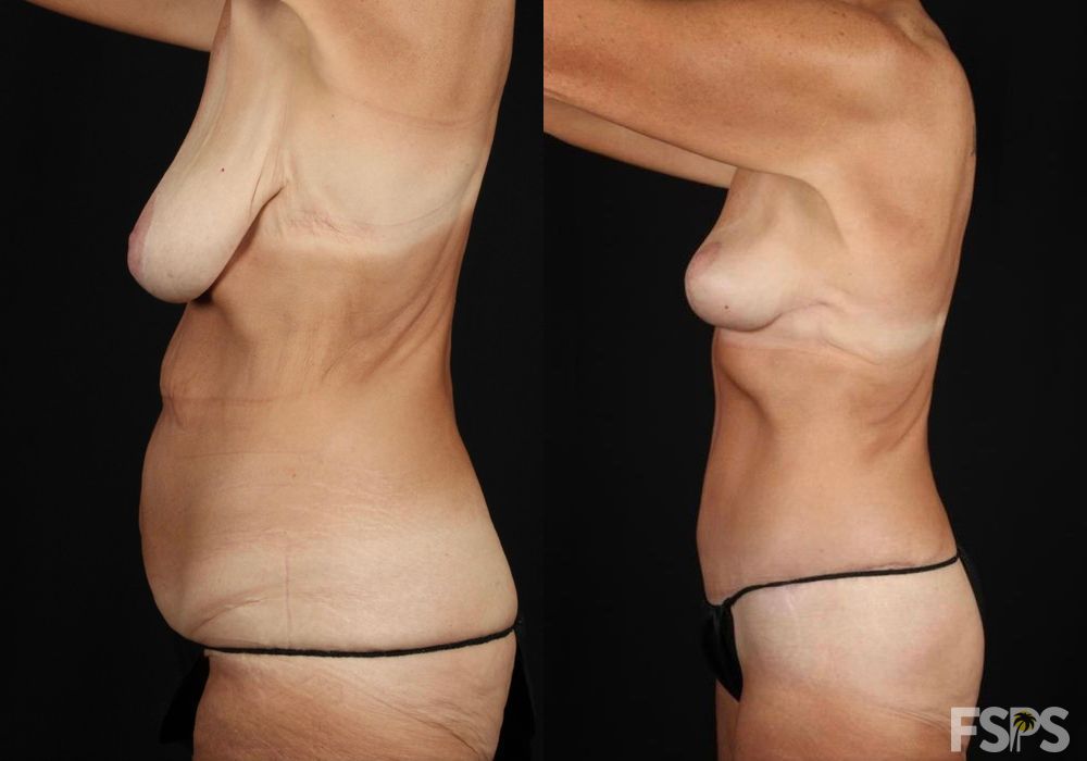 Tummy Tuck - Thumbnail 2