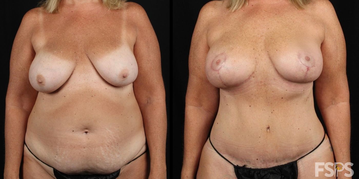 Tummy Tuck - Thumbnail 3