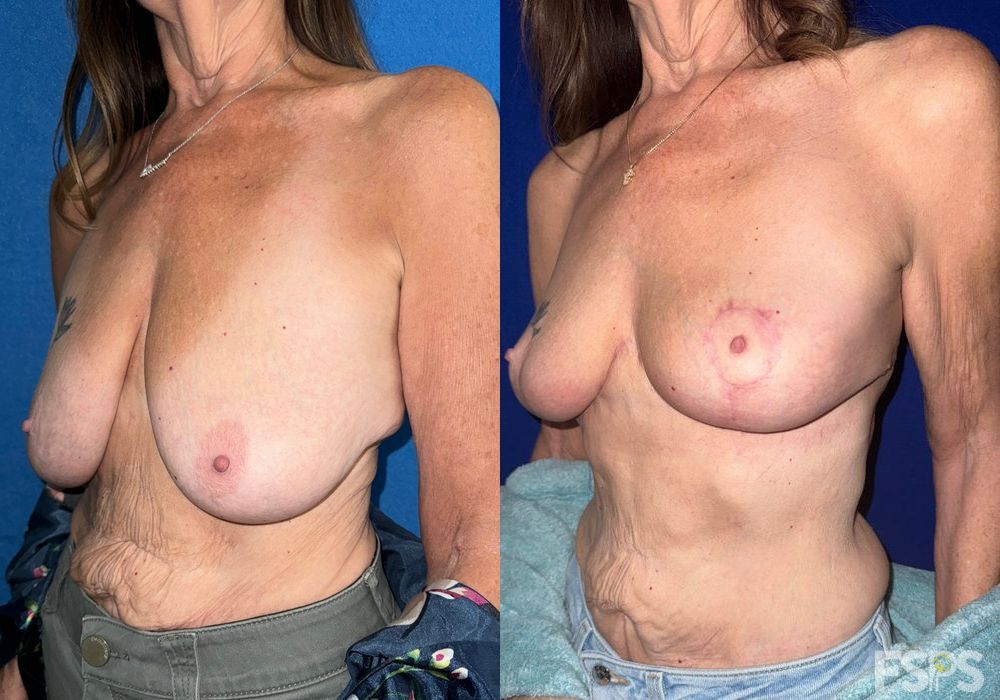 Before photo - Angle 3