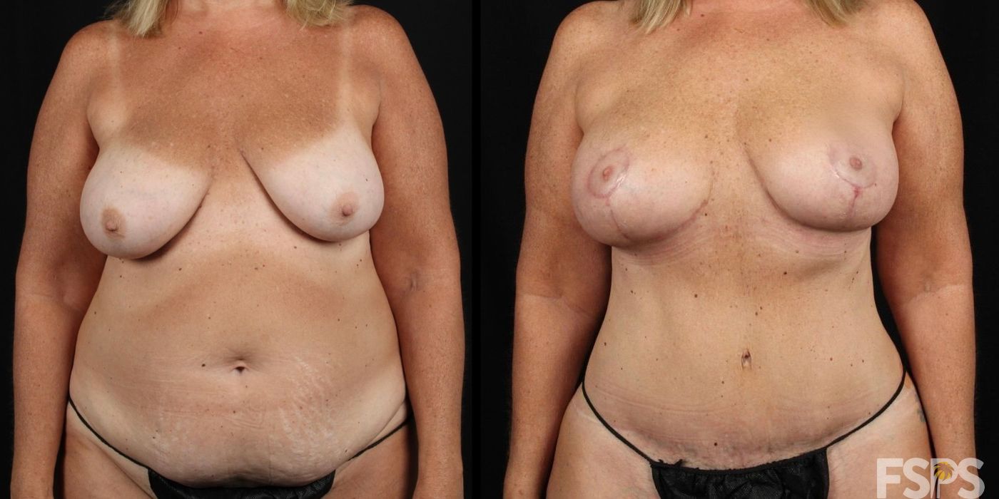 Mommy Makeover - Thumbnail 3