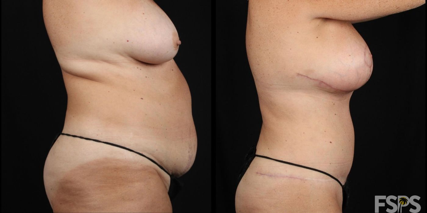 Mommy Makeover - Thumbnail 2