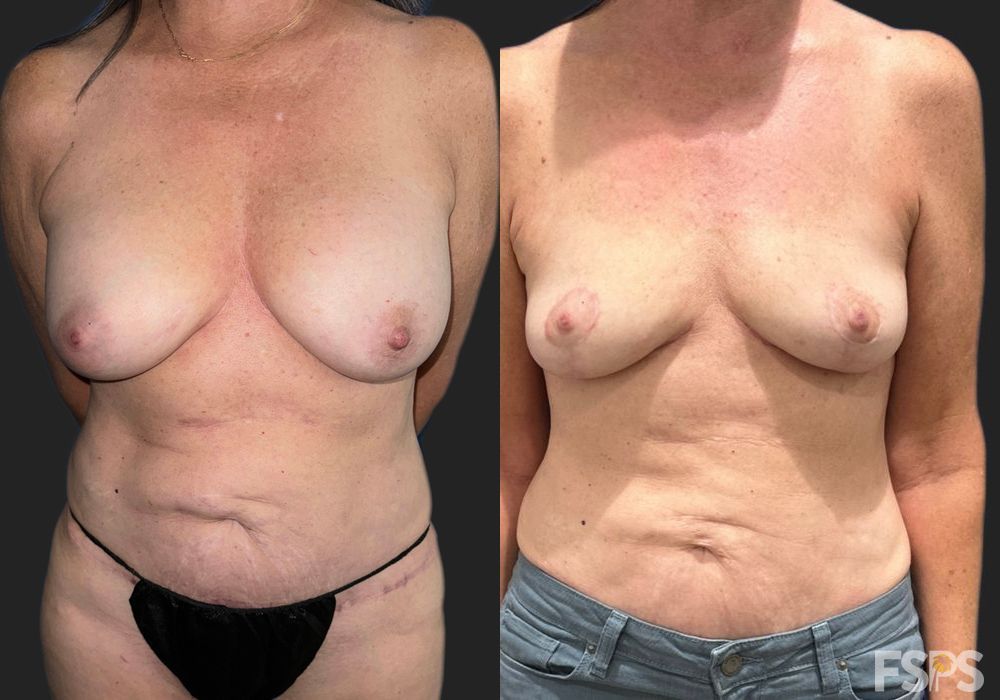 Explant or Implant Removal - Case 22966