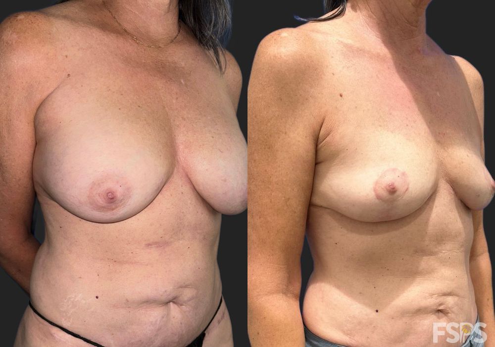 Explant or Implant Removal - Thumbnail 2