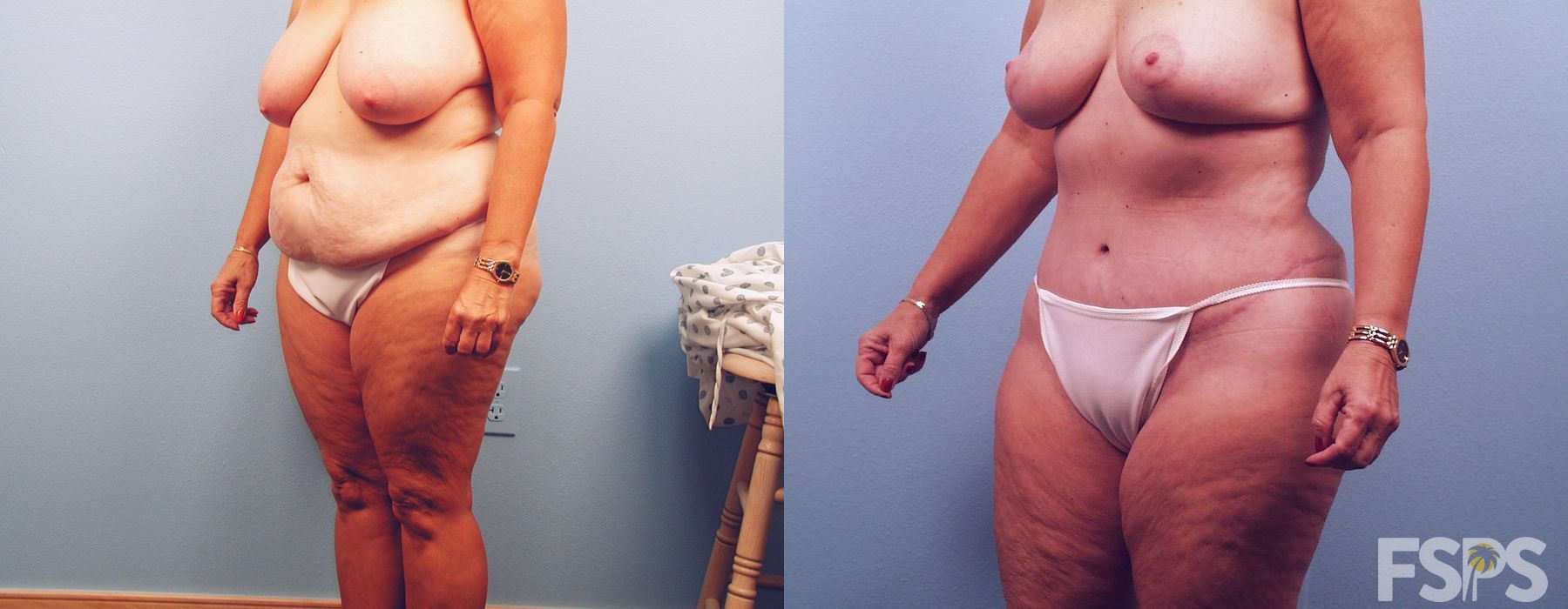 Mommy Makeover - Thumbnail 2