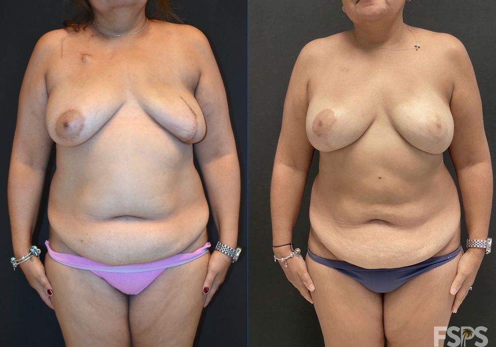 Breast Reduction - Case 22673