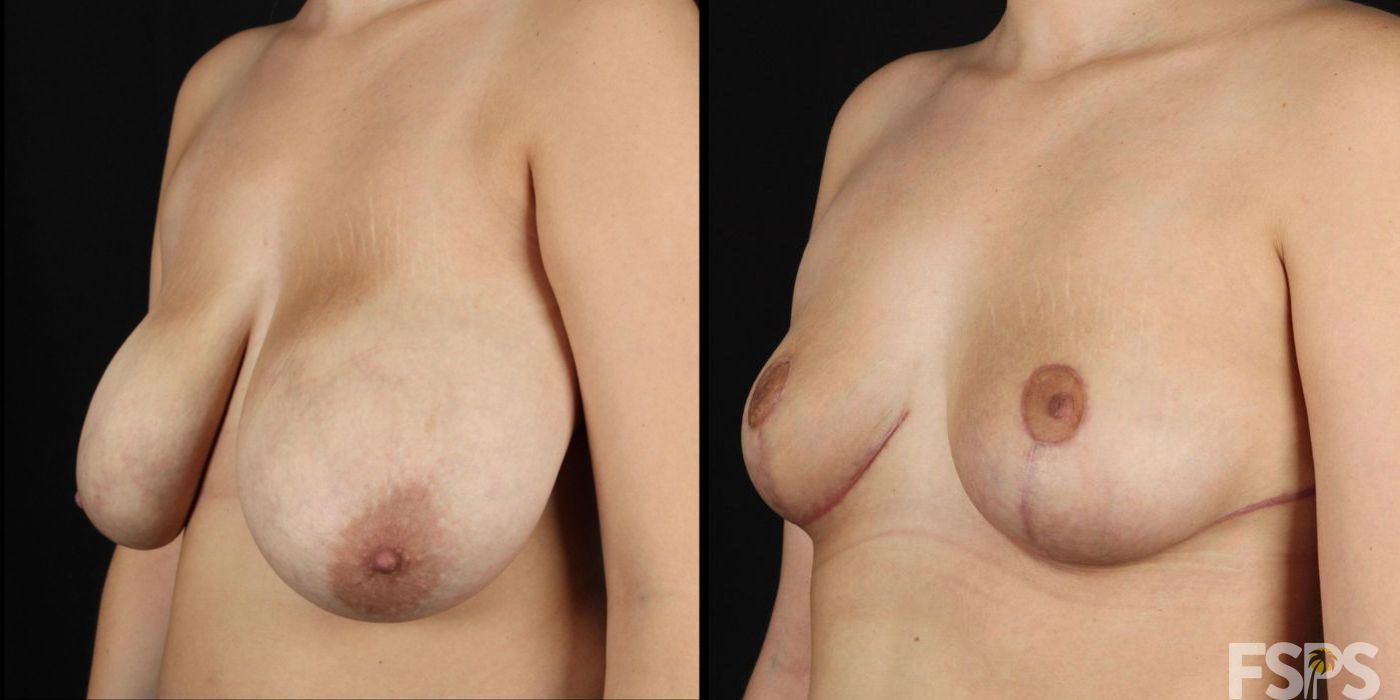 Breast Reduction - Case 22797