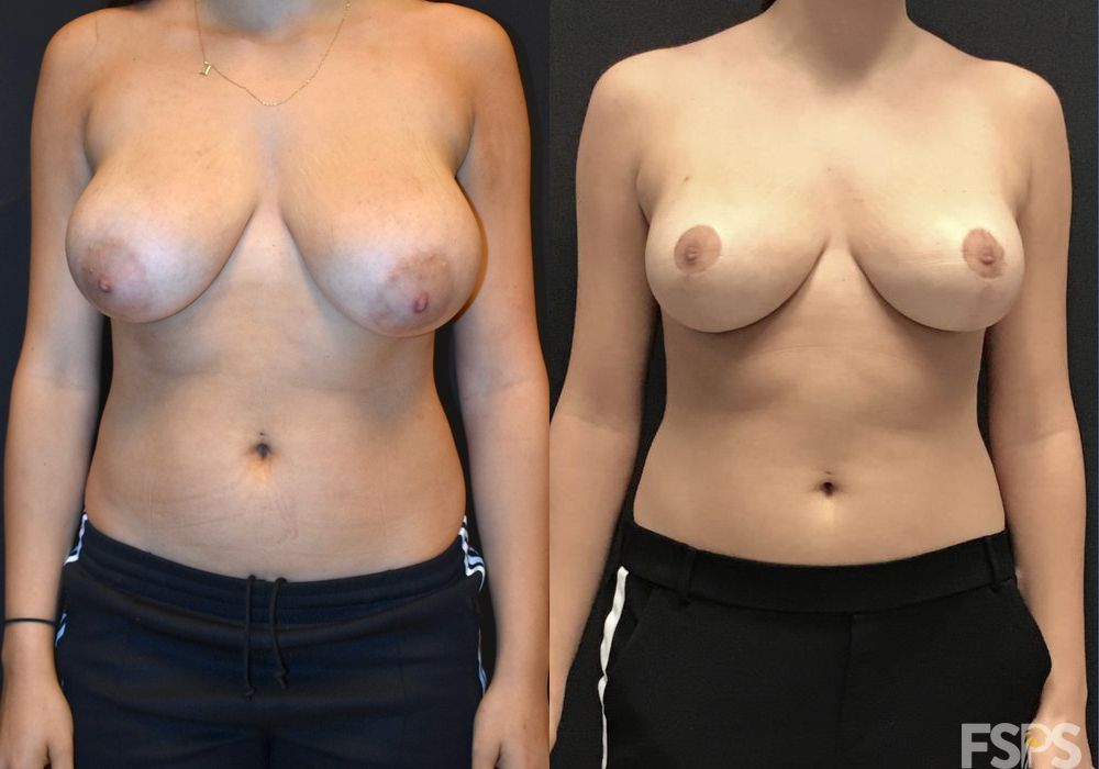 Breast Reduction - Case 22801