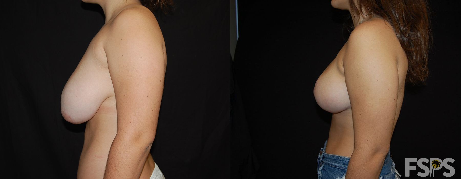 Breast Reduction - Thumbnail 3