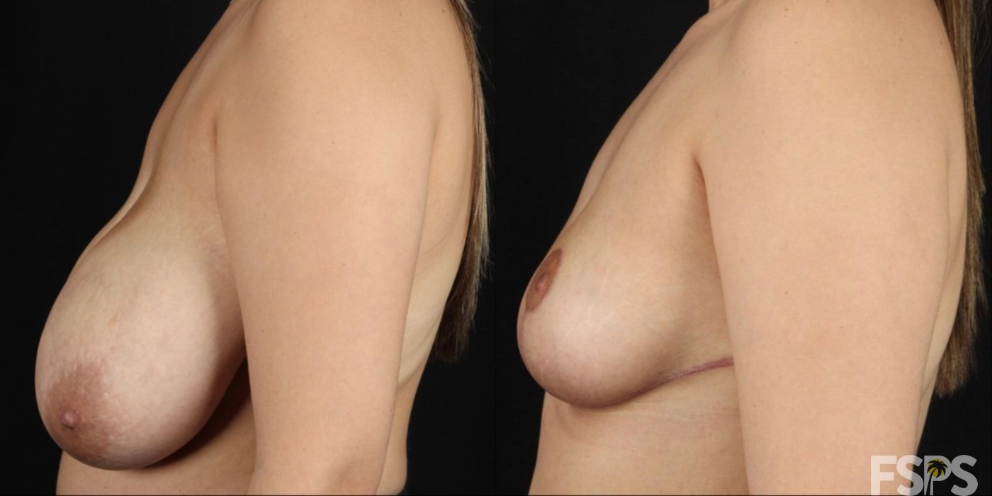 Breast Reduction - Thumbnail 2