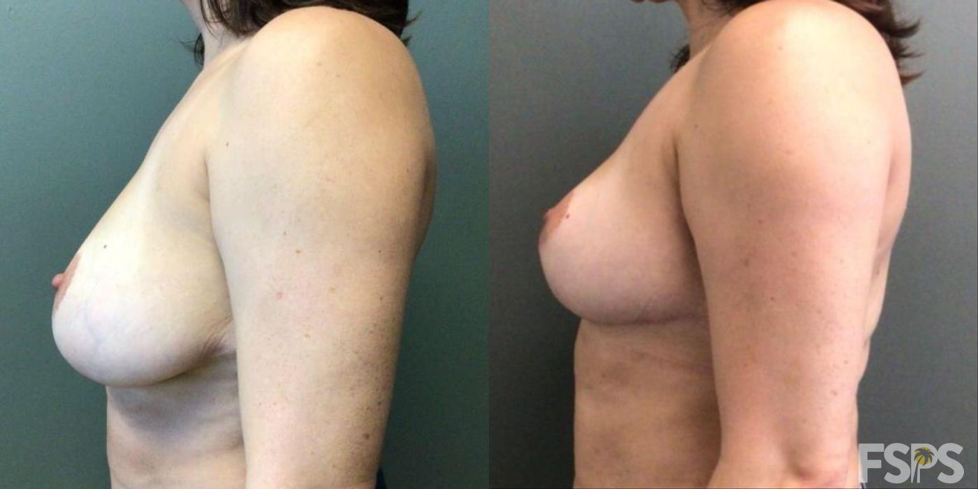 Breast Reduction - Thumbnail 2