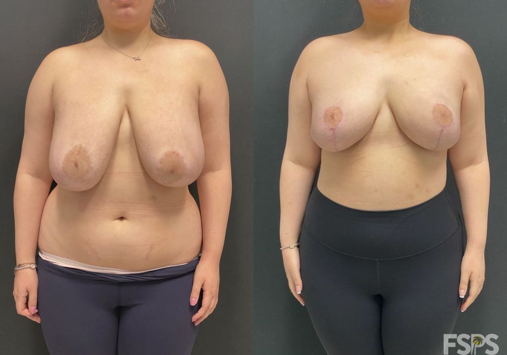 Breast Reduction - Case 22806