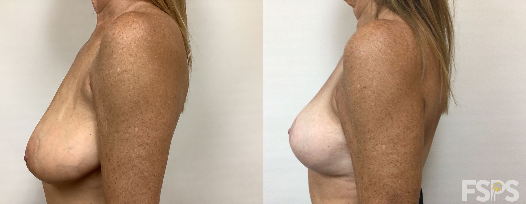 Breast Reduction - Thumbnail 3