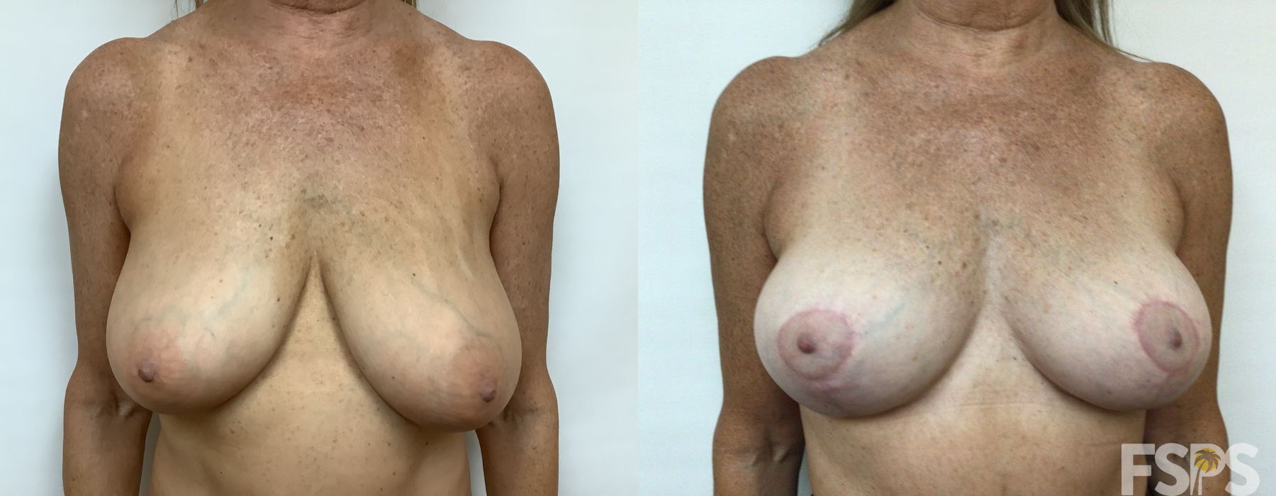 Breast Reduction - Case 22807