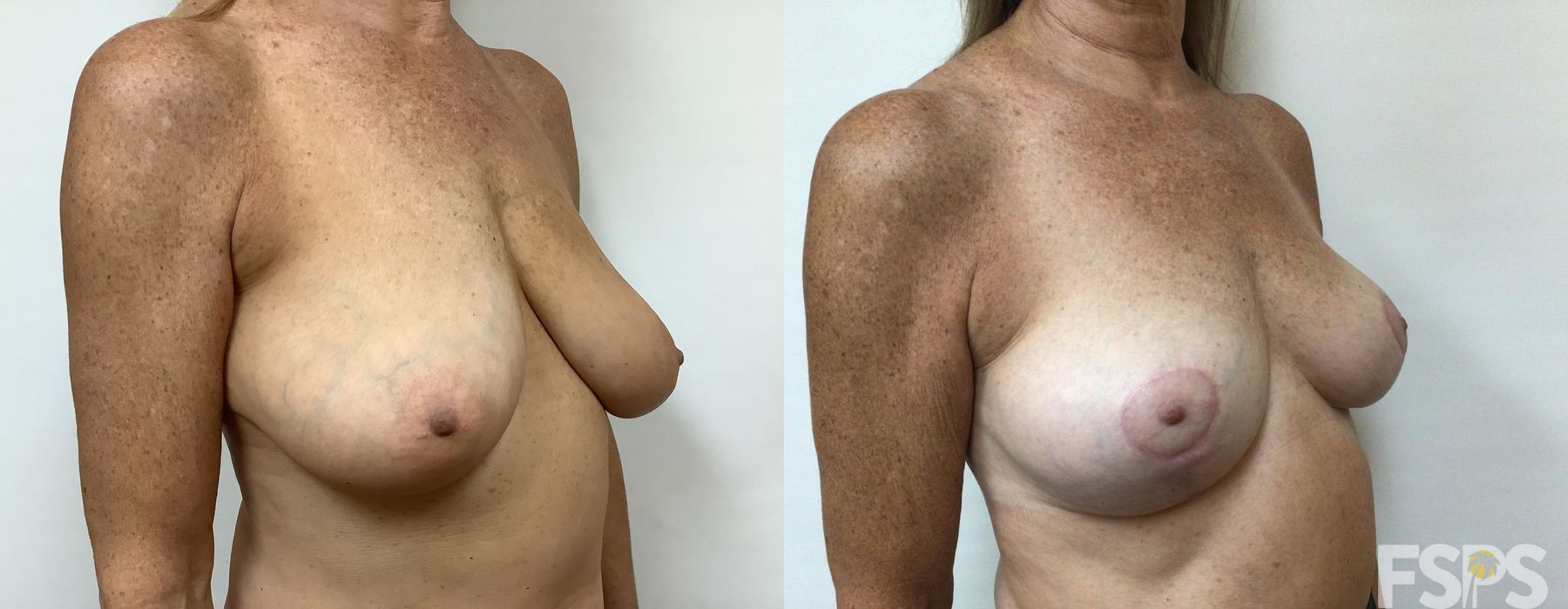 Breast Reduction - Thumbnail 4