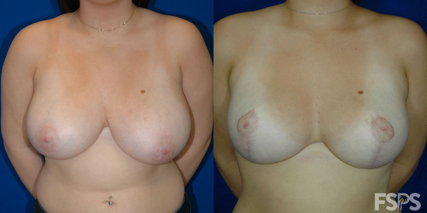 Breast Reduction - Thumbnail 3