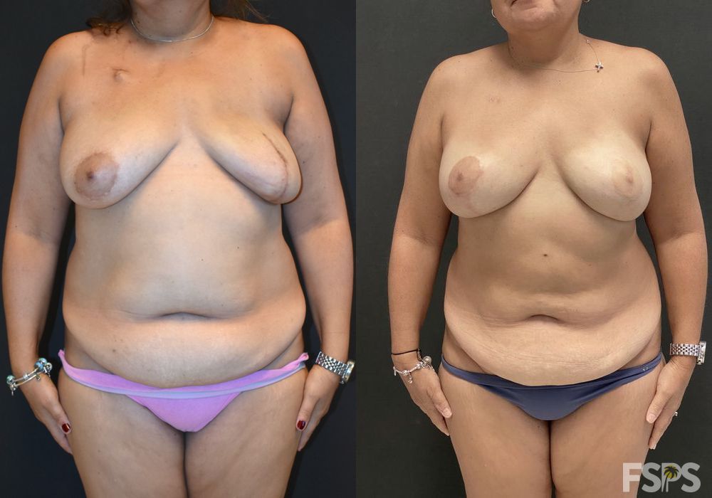 Breast Reduction - Case 22802
