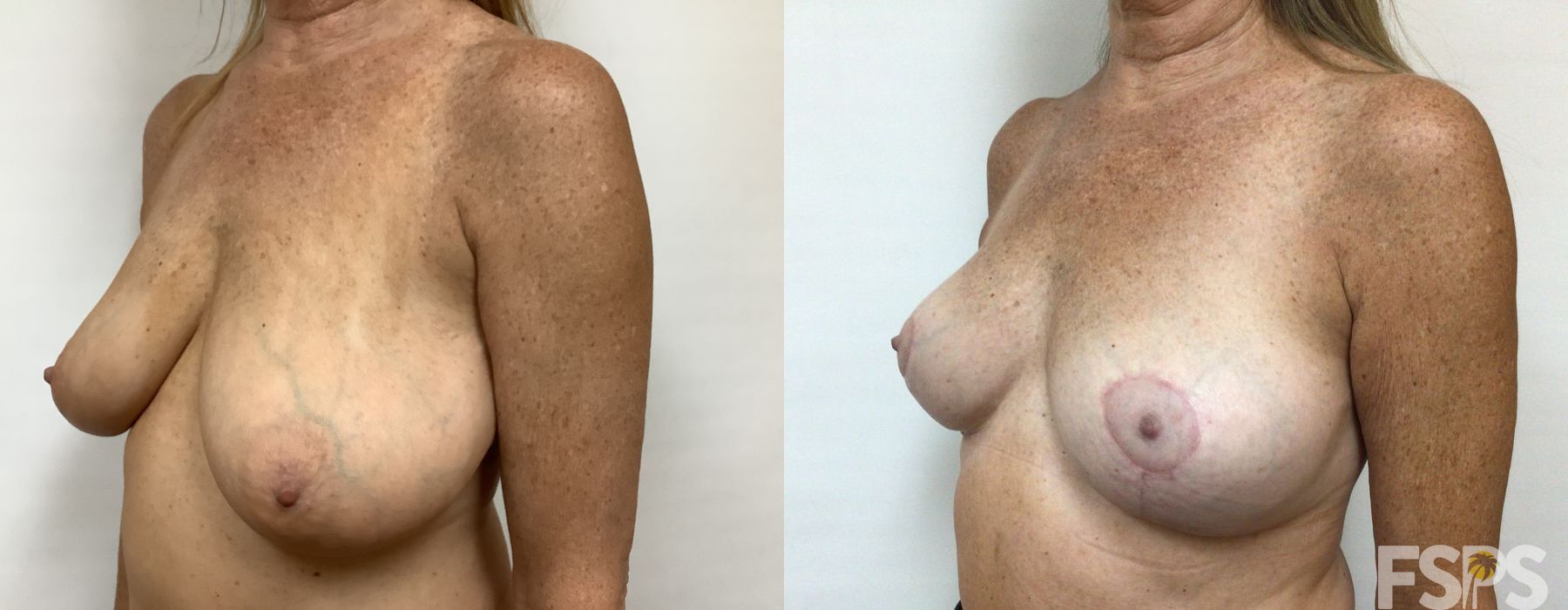 Breast Reduction - Thumbnail 2