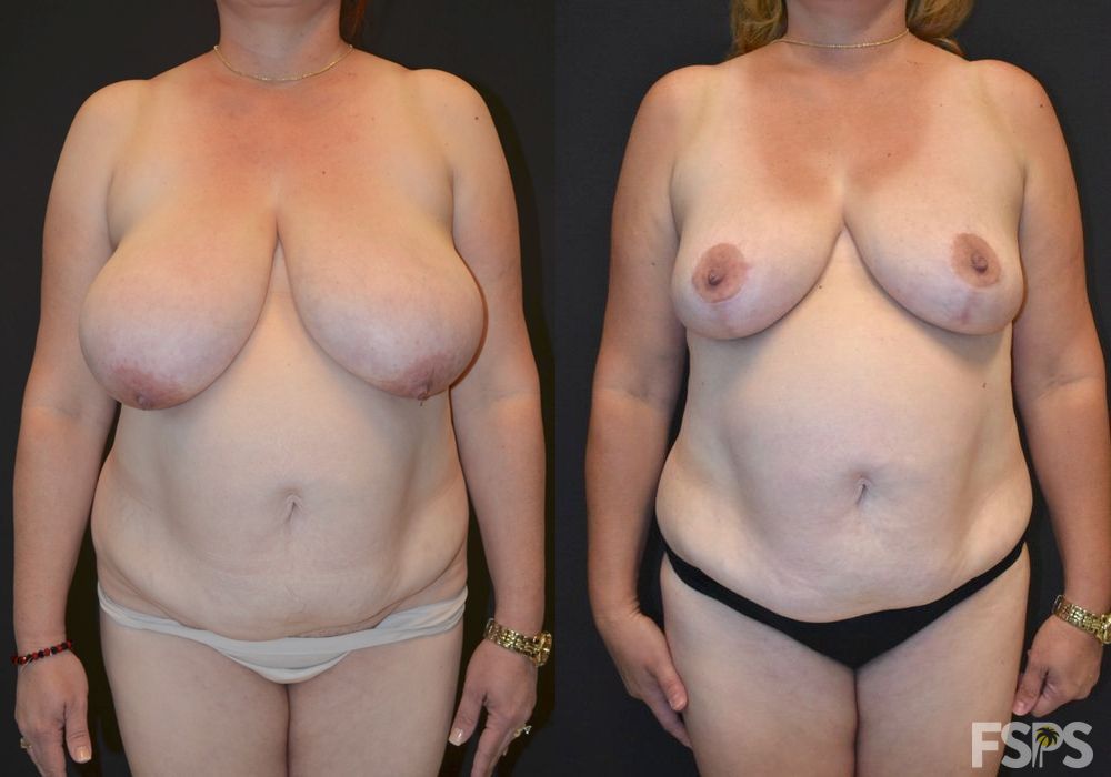 Breast Reduction - Case 22803