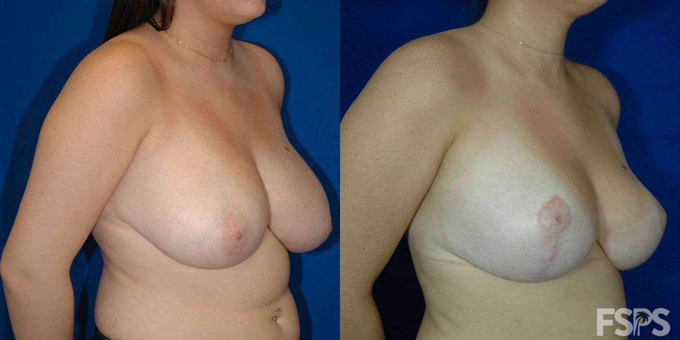 Breast Reduction - Thumbnail 2