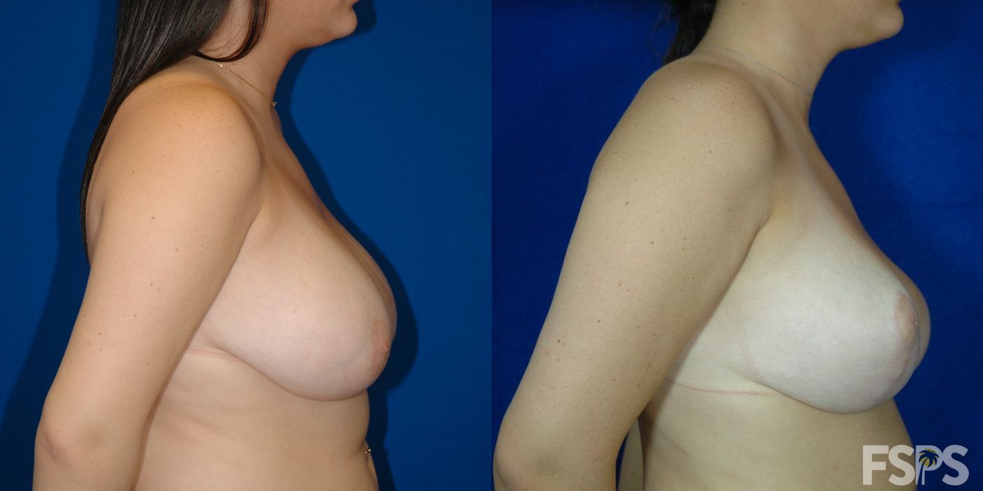 Breast Reduction - Case 22859