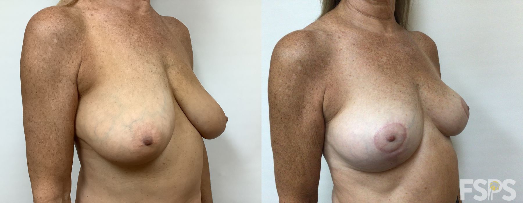 Breast Reduction - Thumbnail 4