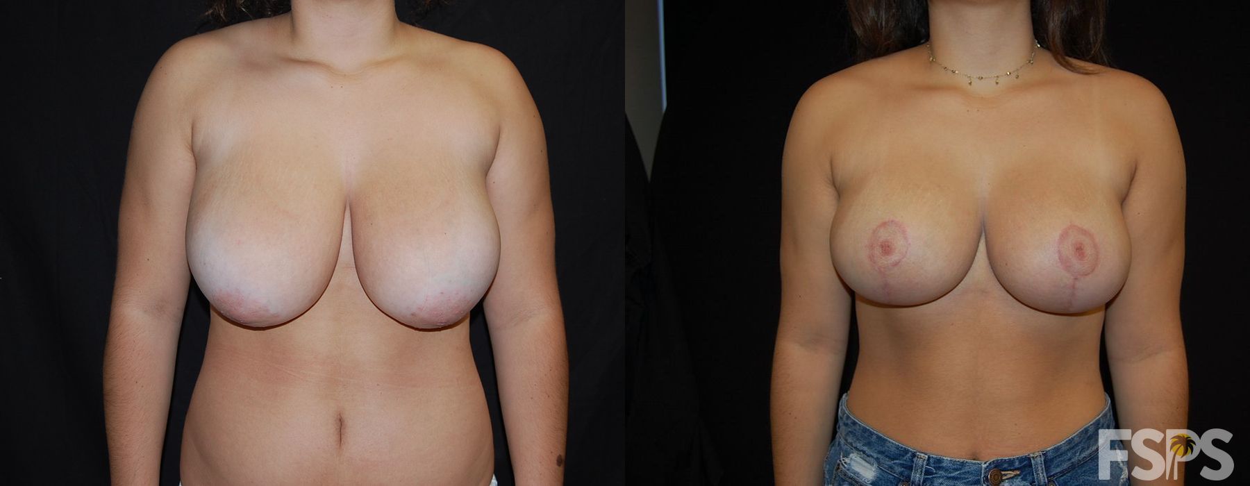 Breast Reduction - Case 22796