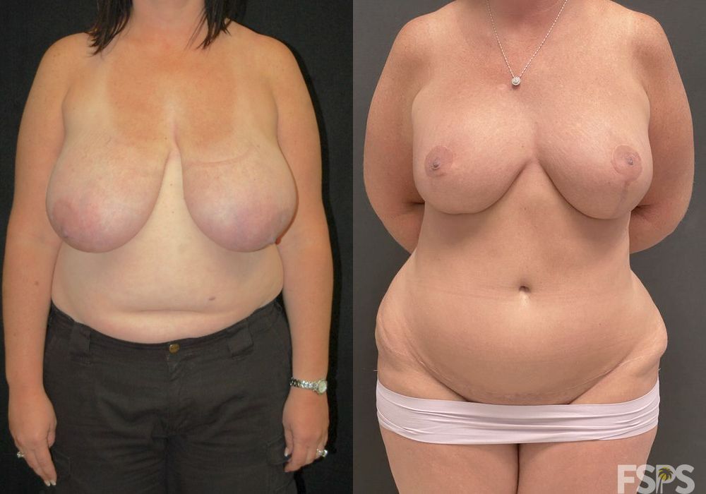 Breast Reduction - Case 22675