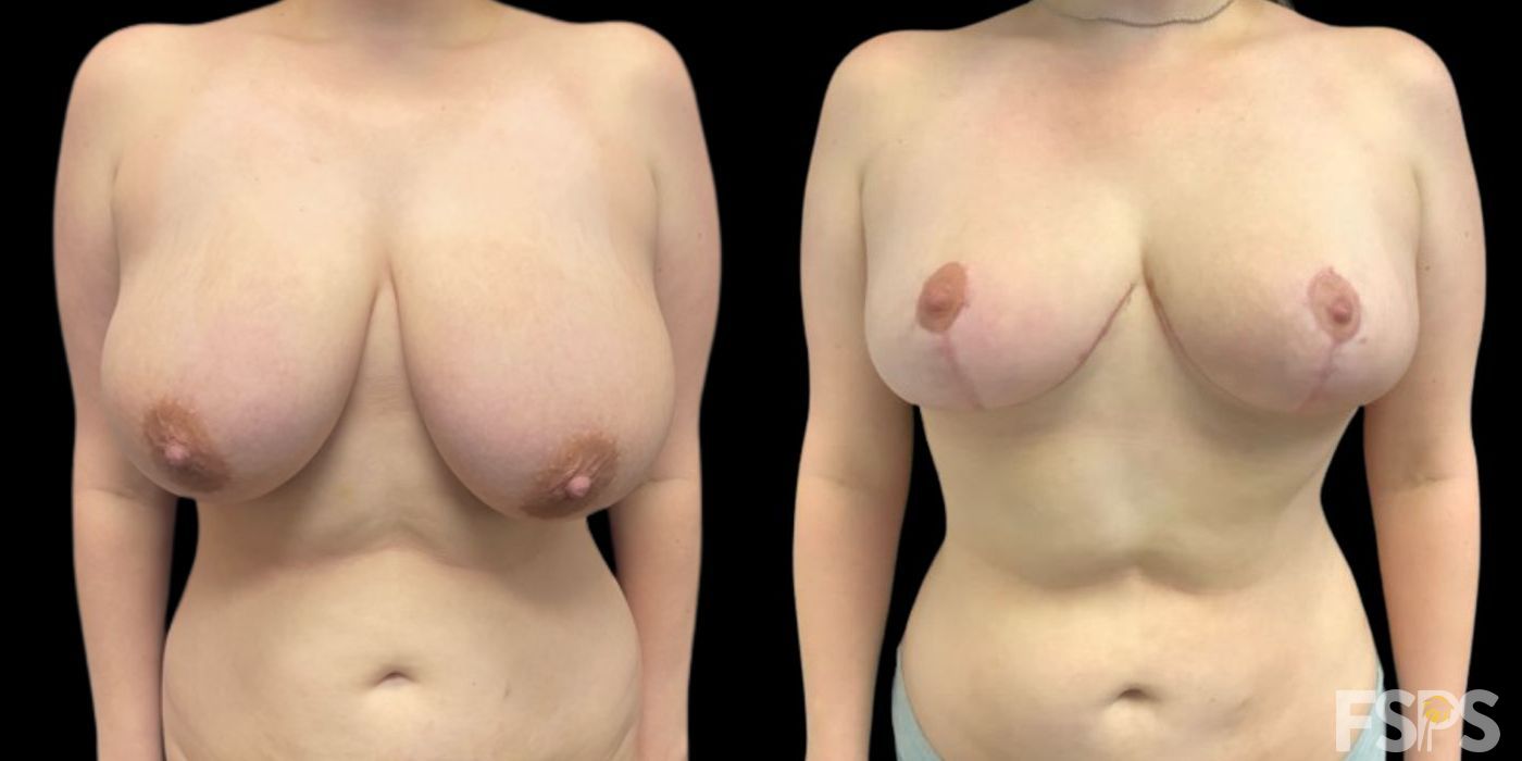 Breast Reduction - Case 22887