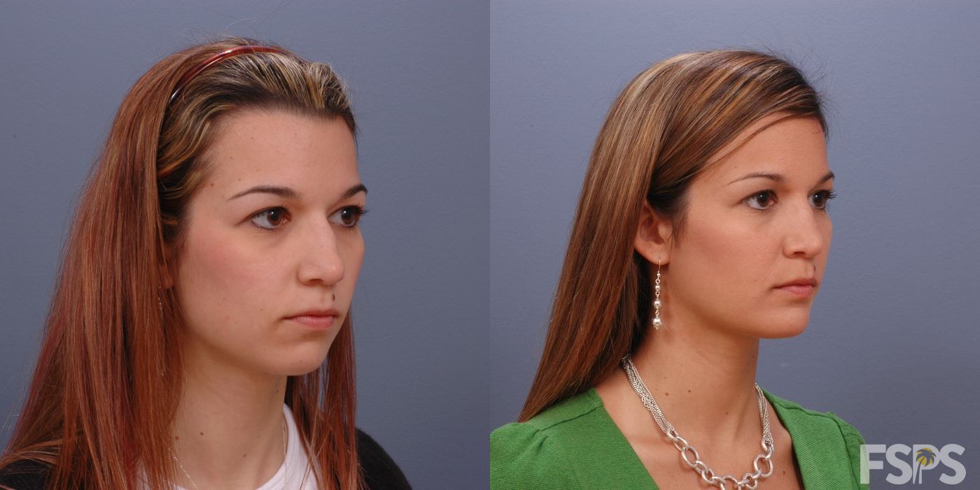 Before photo - Angle 4