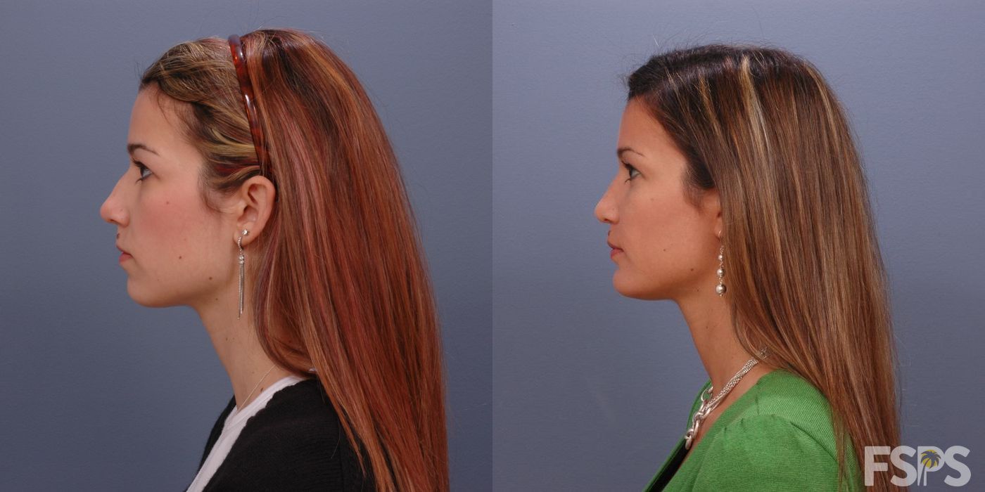 Before photo - Angle 3