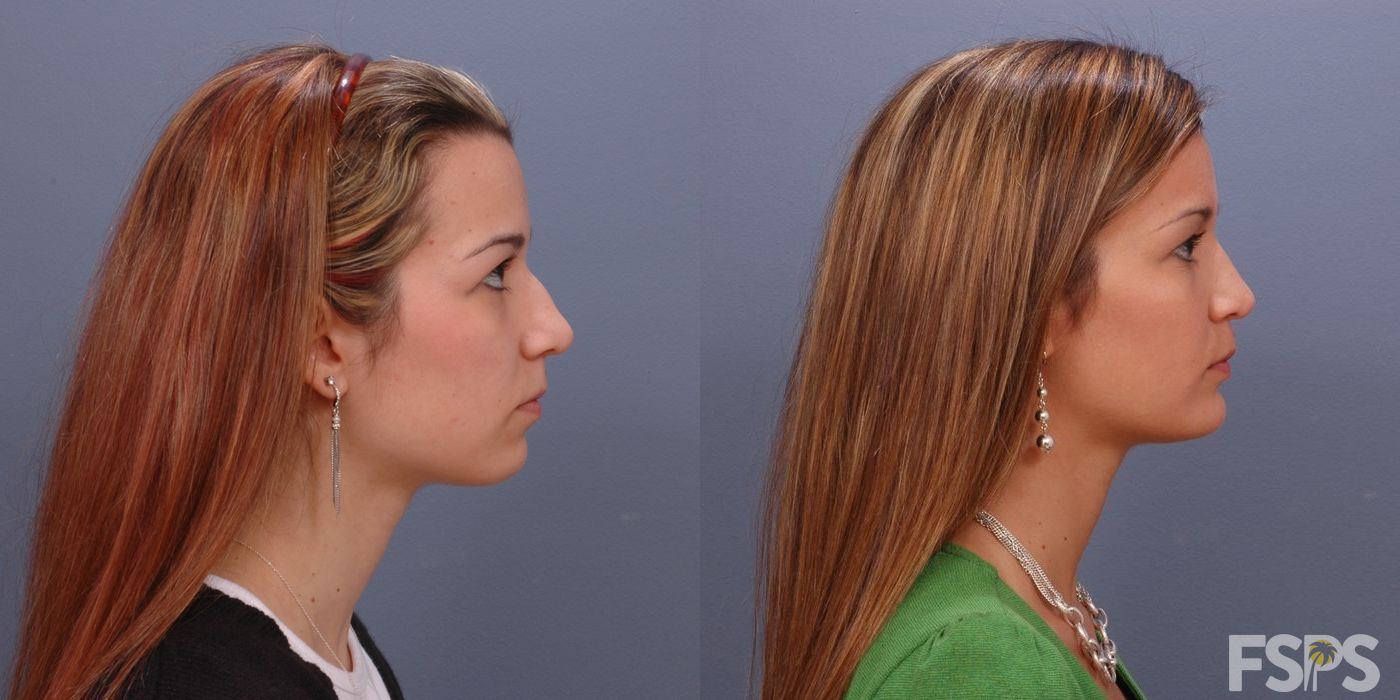 Before photo - Angle 2