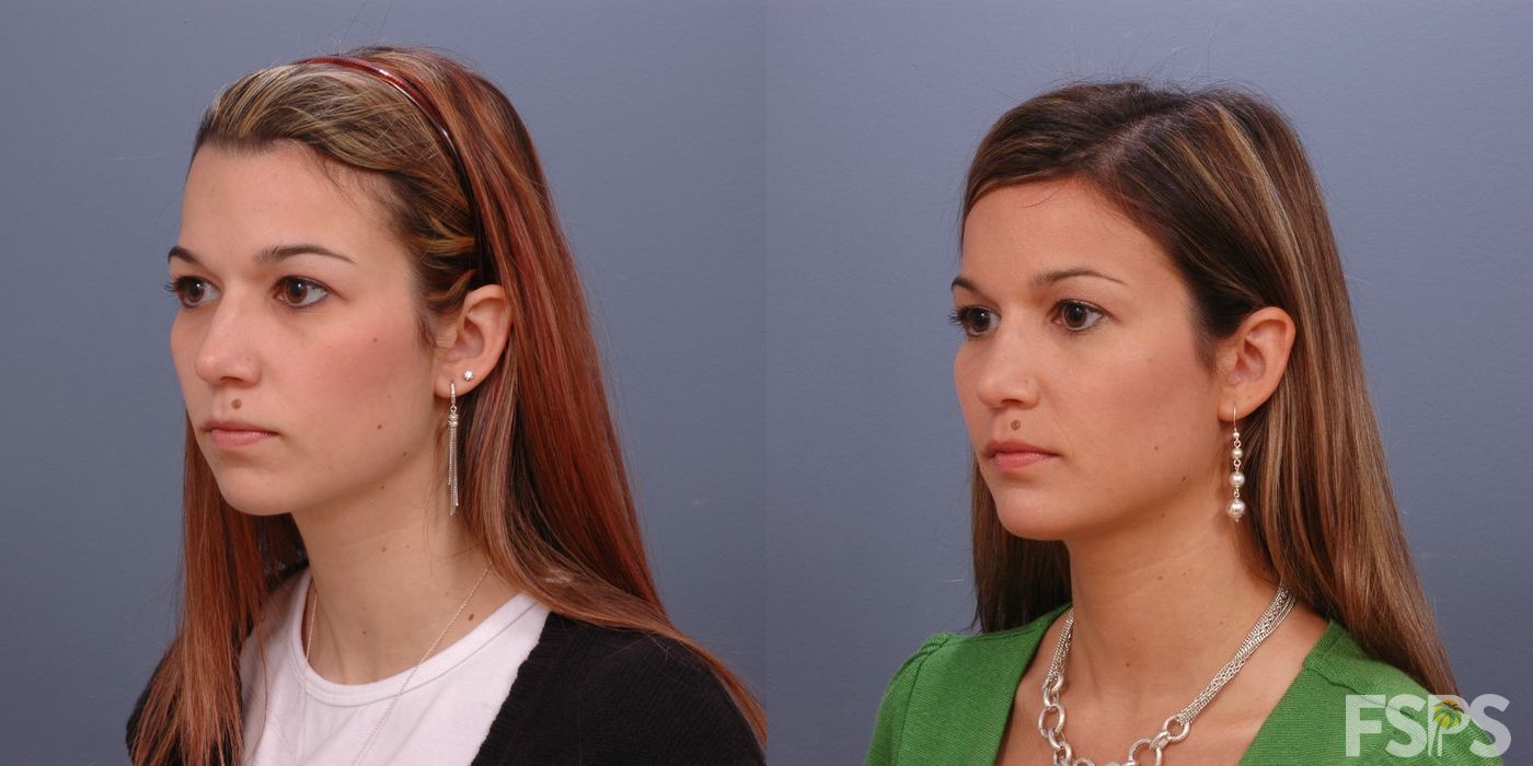 Before photo - Angle 5