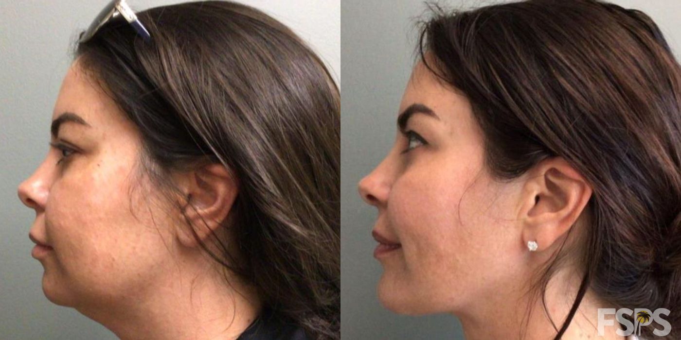 Chin Augmentation - Thumbnail 3