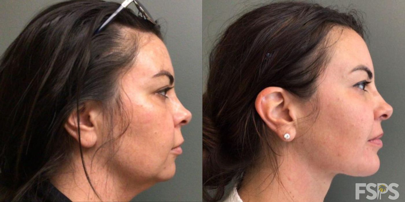 Chin Augmentation - Thumbnail 2