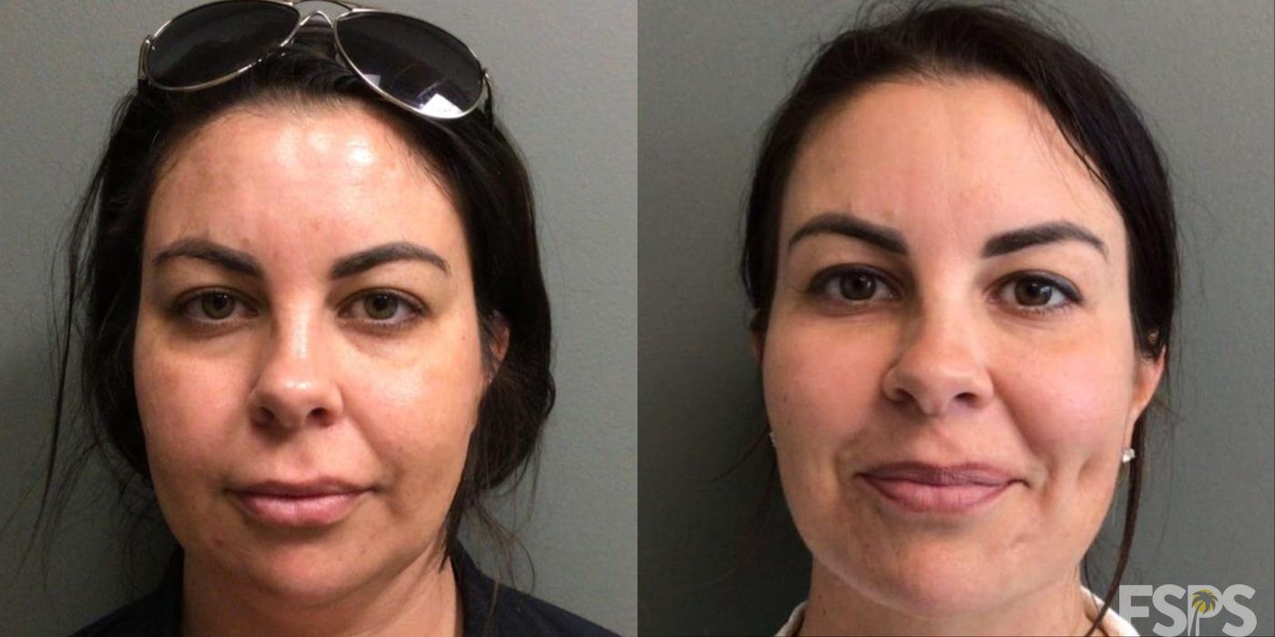 Neck Lift - Thumbnail 2