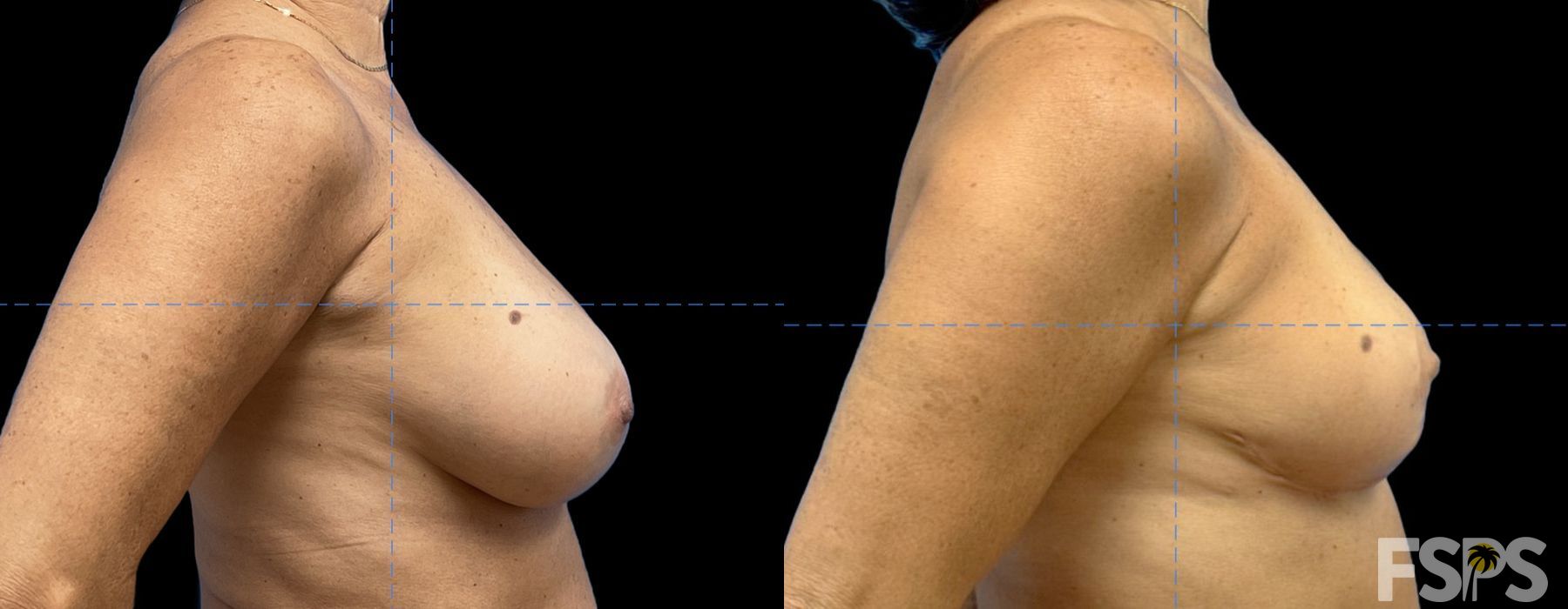 Explant or Implant Removal - Thumbnail 2