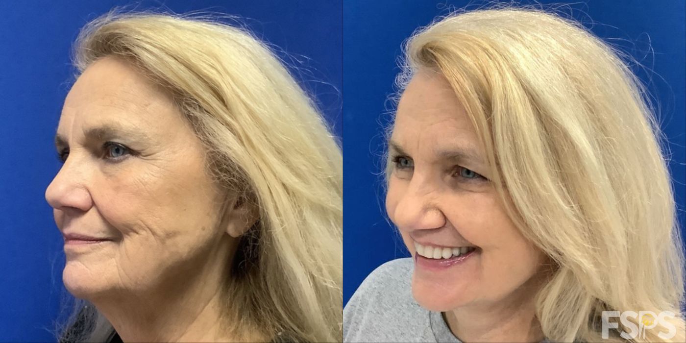 Neck Lift - Thumbnail 2