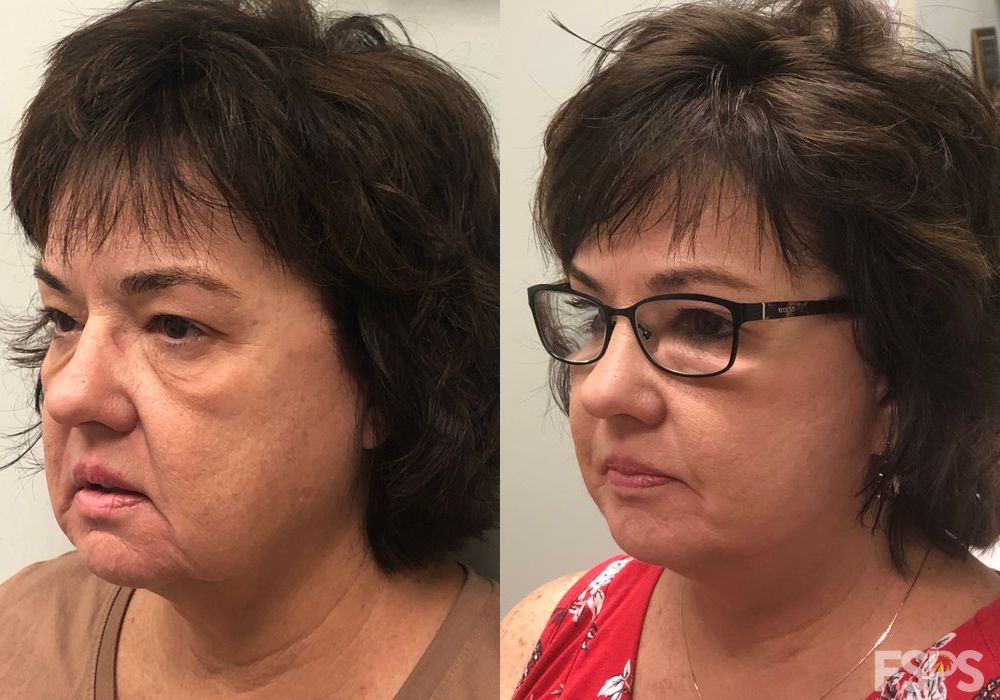 Facelift - Thumbnail 3