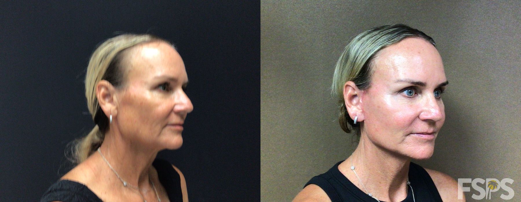 Before photo - Angle 3