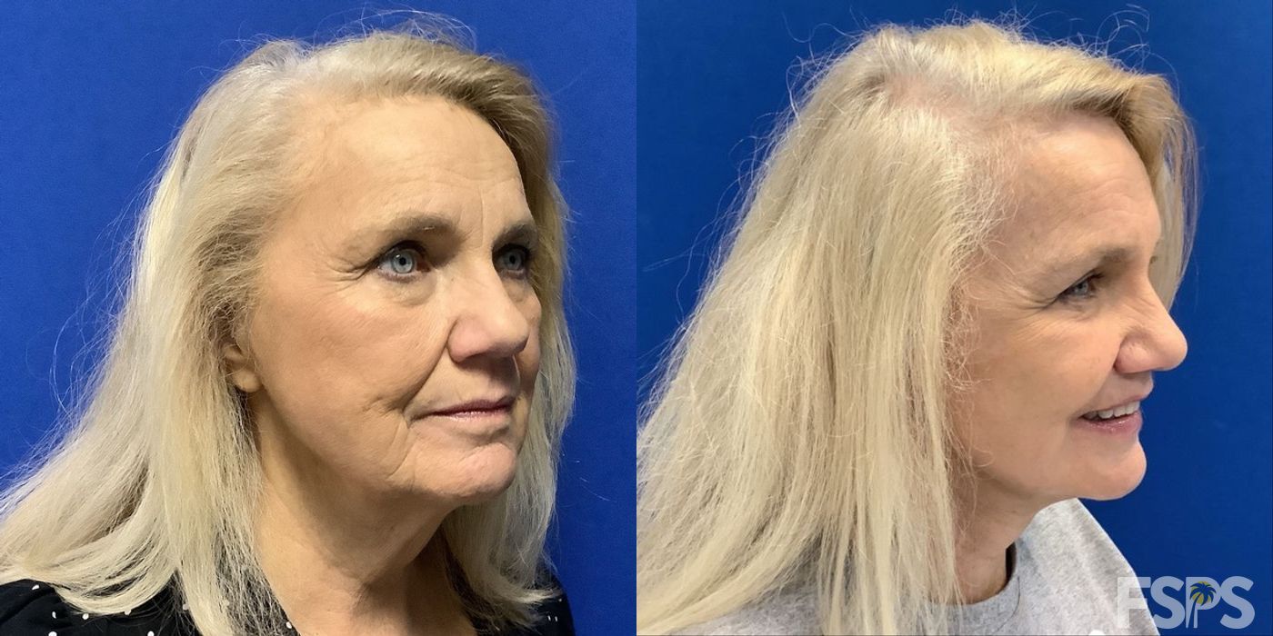 Neck Lift - Case 22831