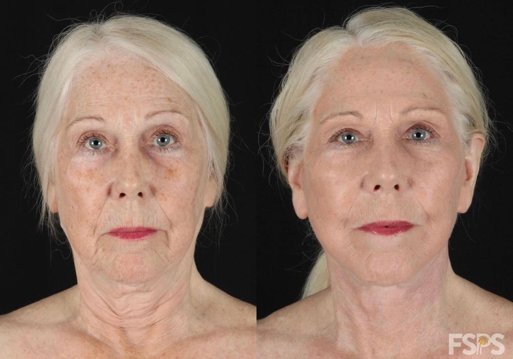 Facelift - Thumbnail 2